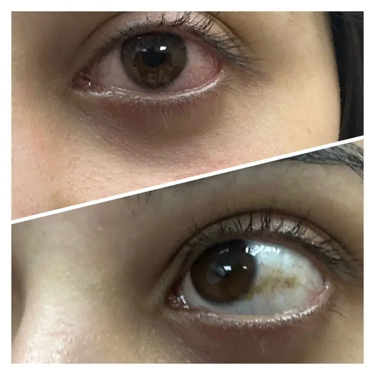 conjunctival-naevi-4