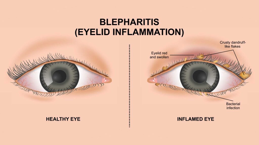 blog-image-blepharitis