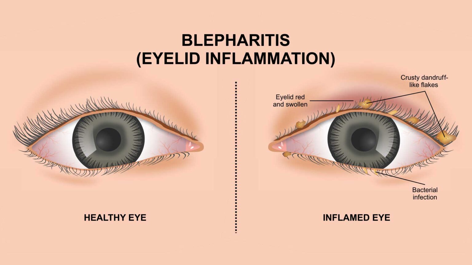 Blepharitis Treatment Your Guide To Relief