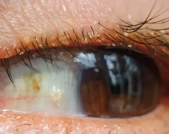 blog-image-blepharitis-2
