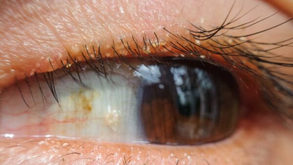 blog-image-blepharitis-2