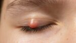 Spot the Difference: Chalazion vs Stye Explained