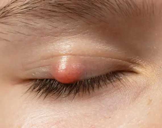 blog-image-chalazion