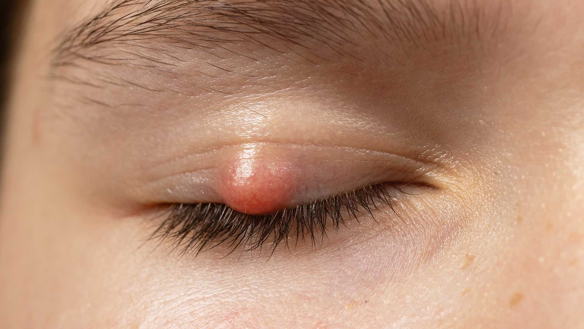 Private Chalazion Removal in London