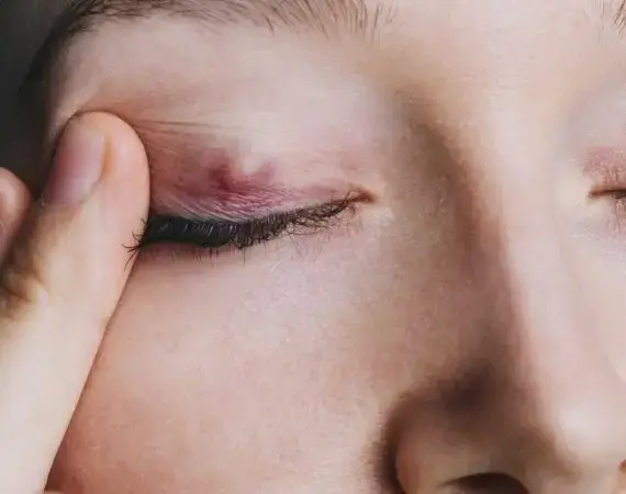 blog-image-chalazion-2