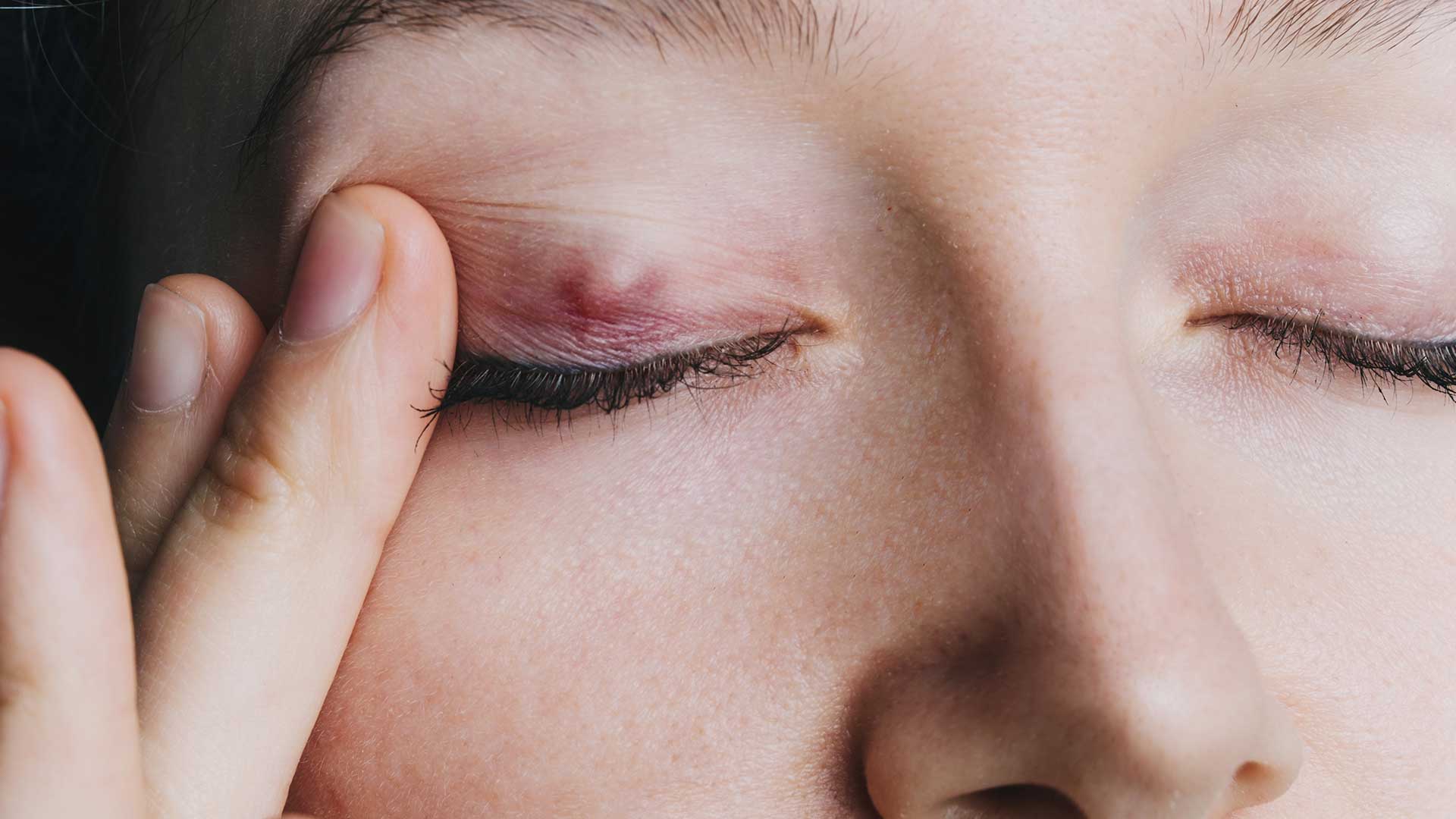 Do Chalazions Go Away? Understanding Eyelid Lumps