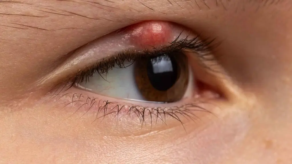 blog-image-chalazion-5