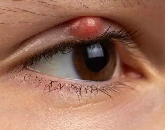 blog-image-chalazion-5