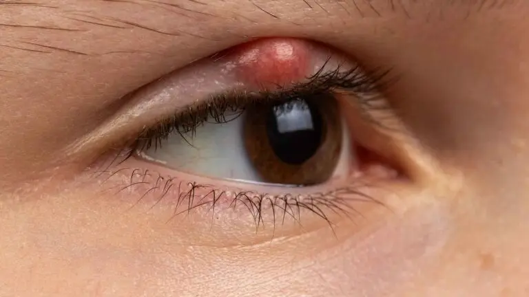 blog-image-chalazion-5