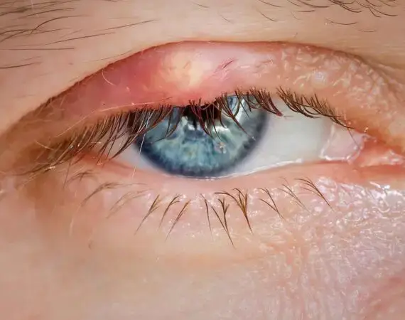blog-image-chalazion-6