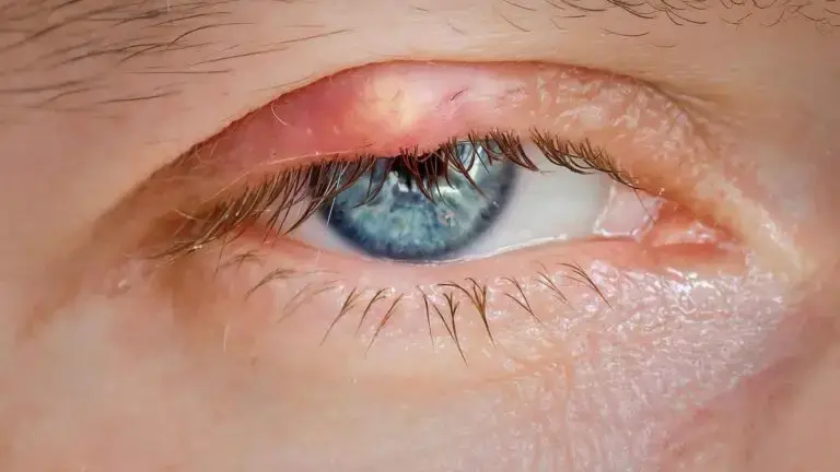 blog-image-chalazion-6