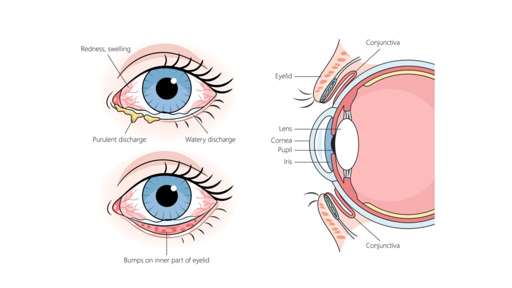 blog-image-conjunctivitis-1