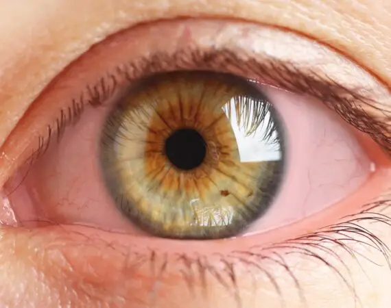 blog-image-conjunctivitis-2