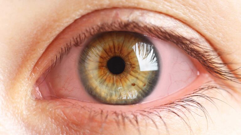 blog-image-conjunctivitis-2