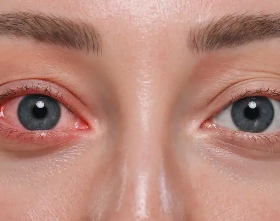 blog-image-conjunctivitis-3