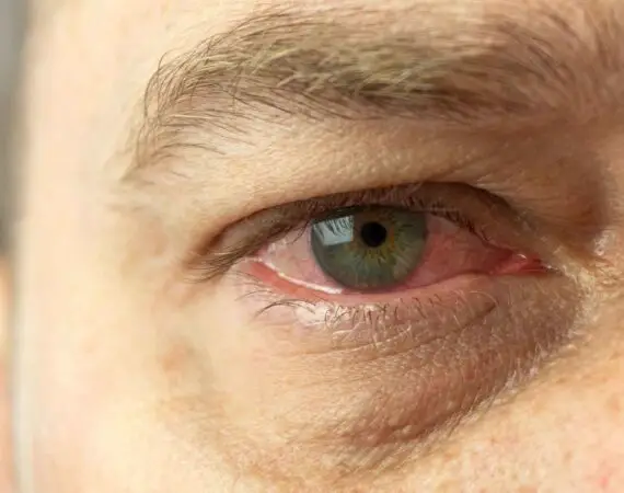 blog-image-conjunctivitis-4