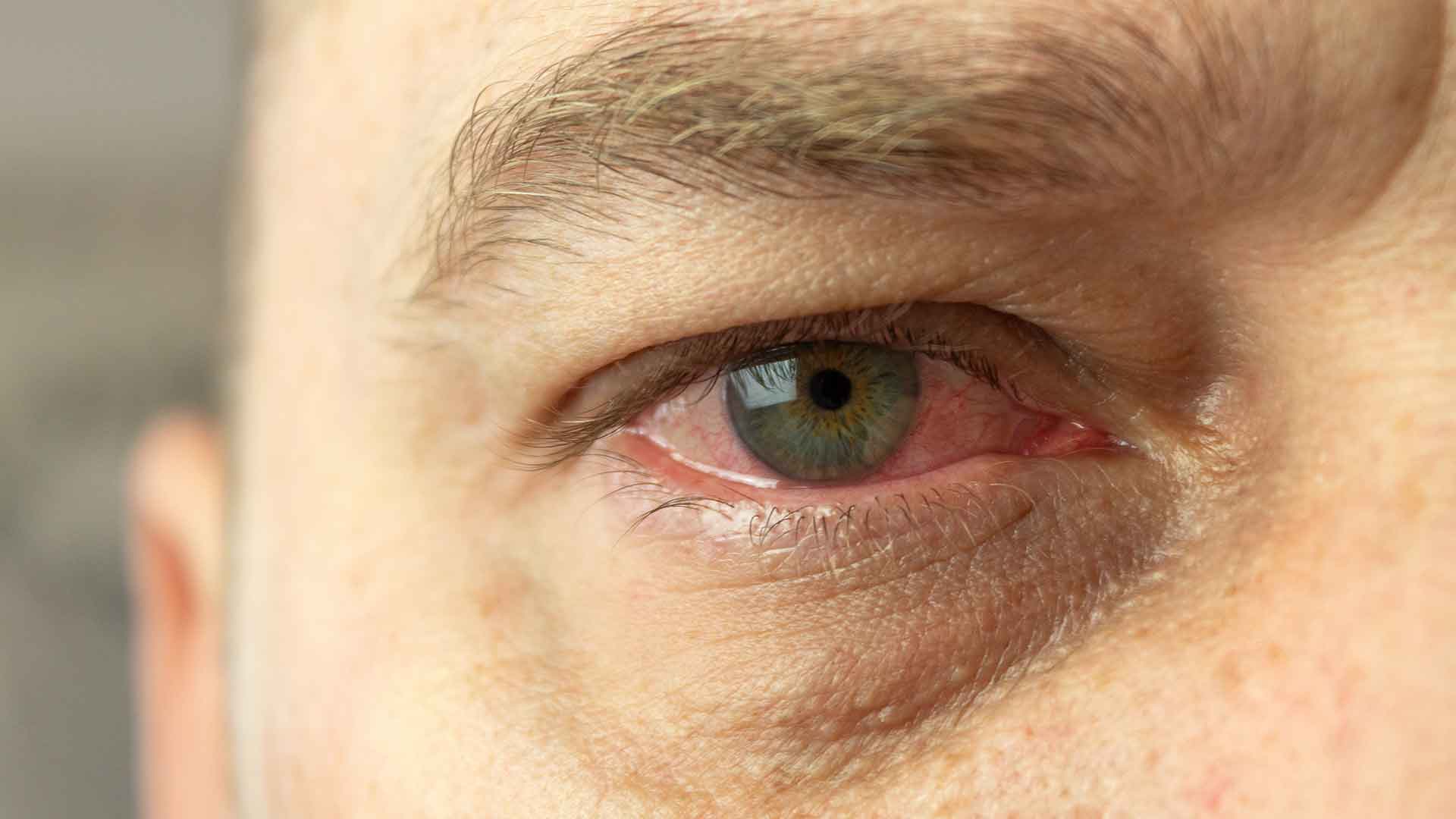 Conjunctivitis Treatment: Expert Care for Pink Eye