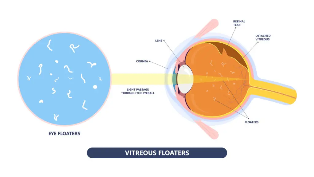 blog-image-floaters-1