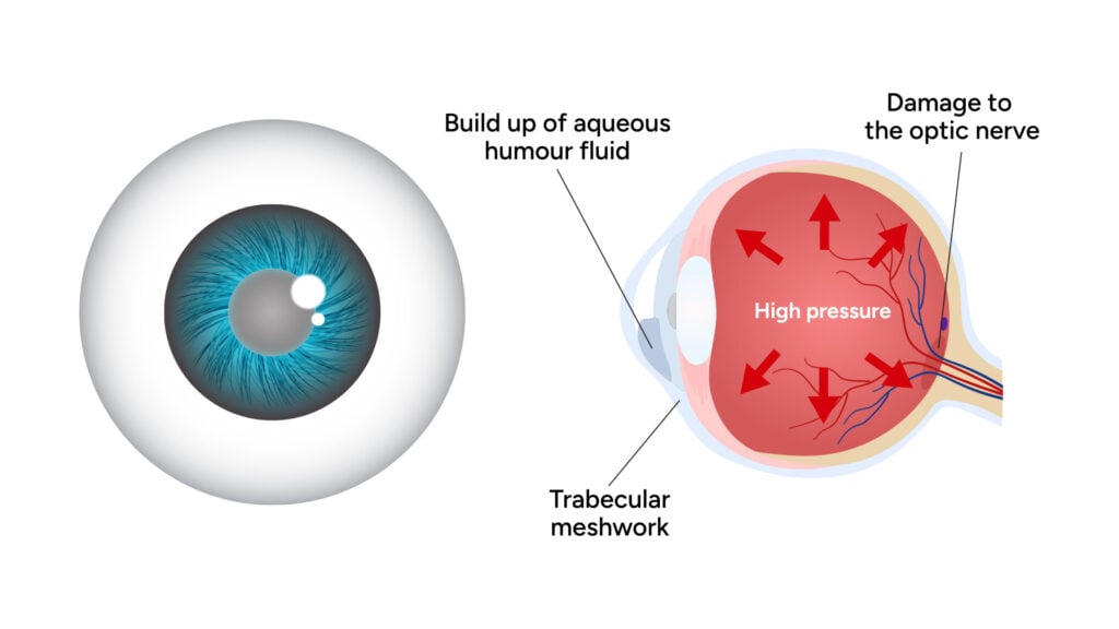 blog-image-glaucoma-1