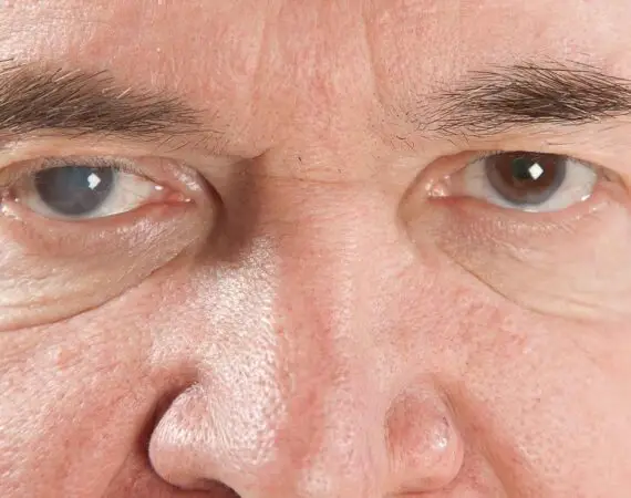 blog-image-glaucoma-2