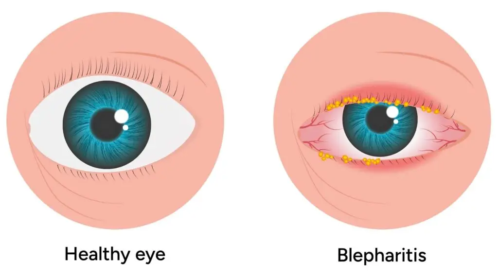 blog-image-blepharitis-1