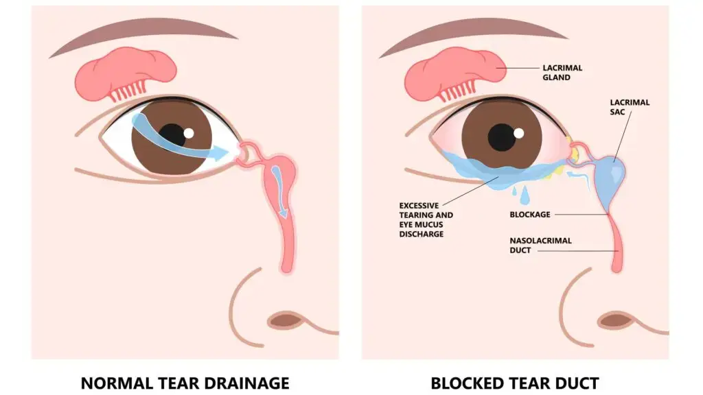 blog-image-blocked-tear-duct