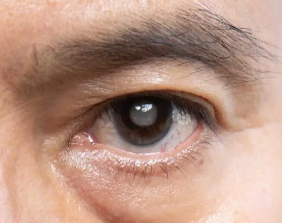 blog-image-cataract-2