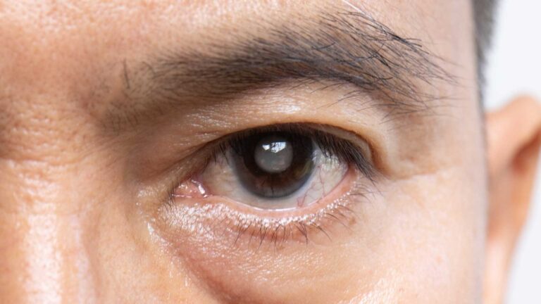 blog-image-cataract-2