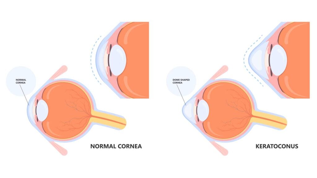 blog-image-keratoconus-1