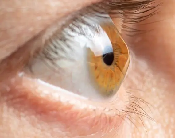blog-image-keratoconus-2