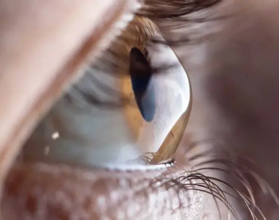 blog-image-keratoconus-3