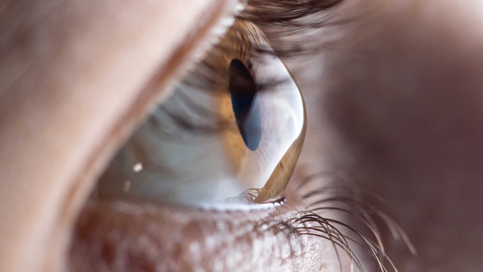 What is Keratoconus?