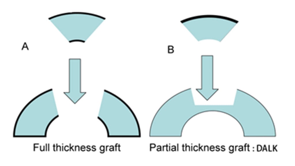 blog-image-keratoconus-4