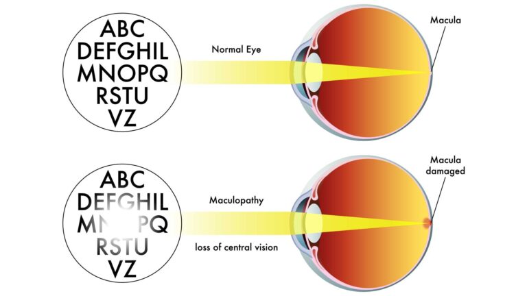 blog-image-maculopathy