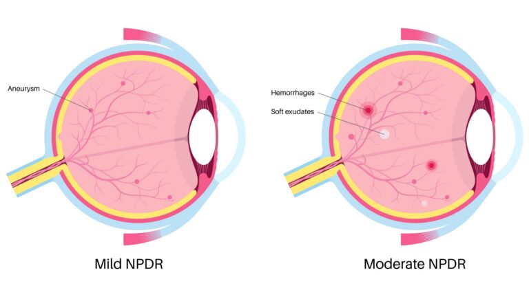 blog-image-mild-moderate-npdr