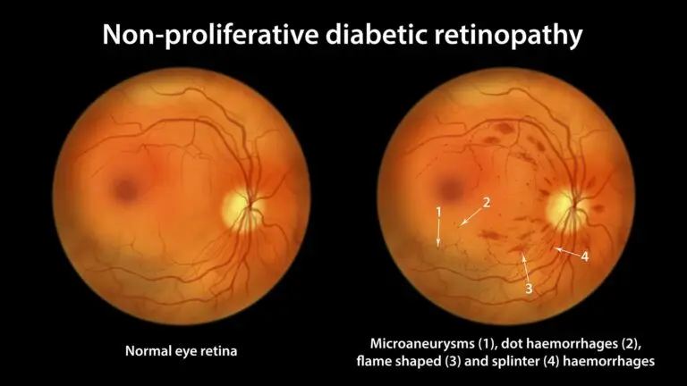 blog-image-non-proliferative-diabetic-retinopathy