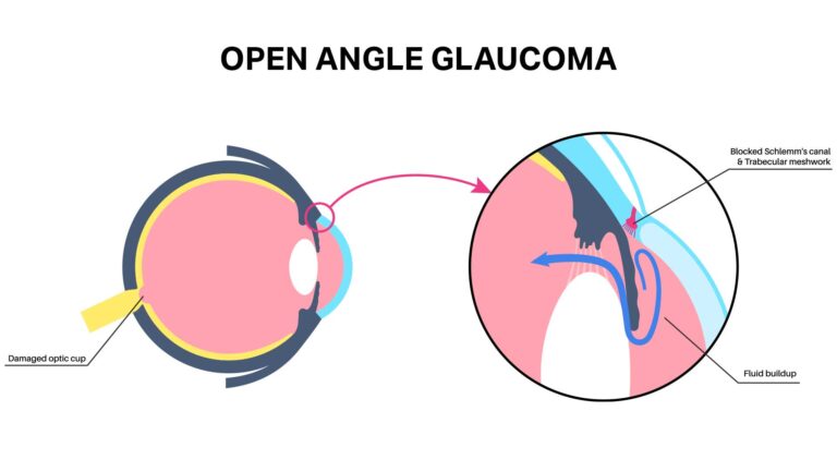 blog-image-open-angle-glaucoma