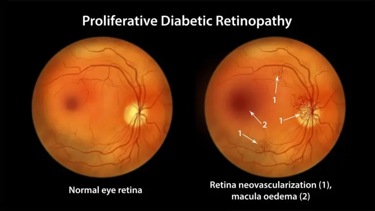 blog-image-proliferative-diabetic-retinopathy