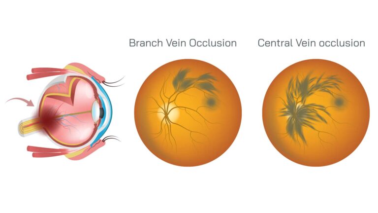 blog-image-retinal-vein-occlusion