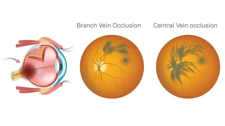 blog-image-retinal-vein-occlusion