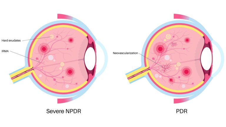 blog-image-severe-npdr-pdr