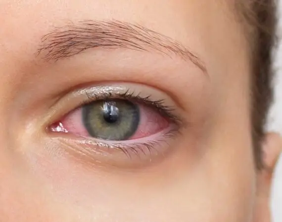 blog-image-uveitis-2