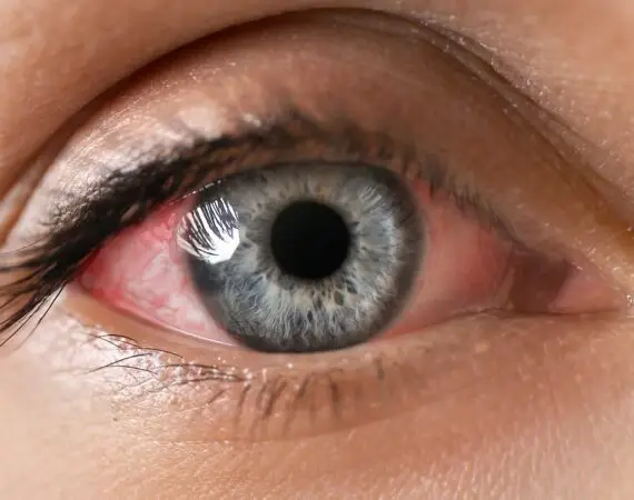 blog-image-uveitis-3