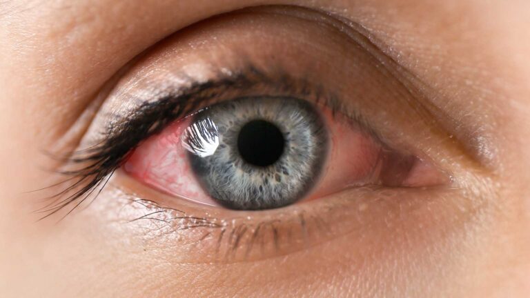 blog-image-uveitis-3