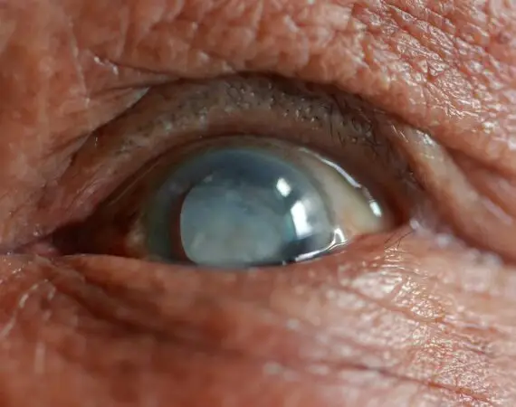 blog-image-cataract-5