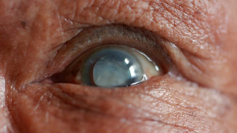 blog-image-cataract-5