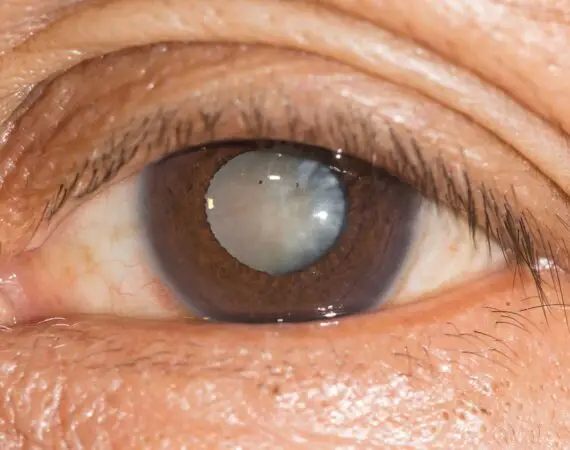 blog-image-cataract-6