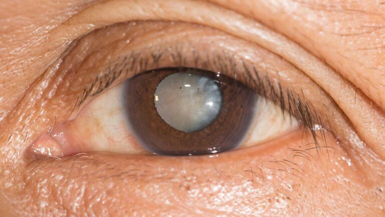 blog-image-cataract-6