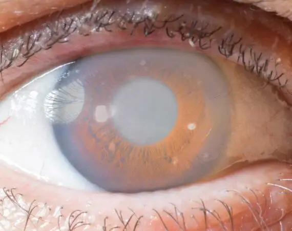 blog-image-cataract-7