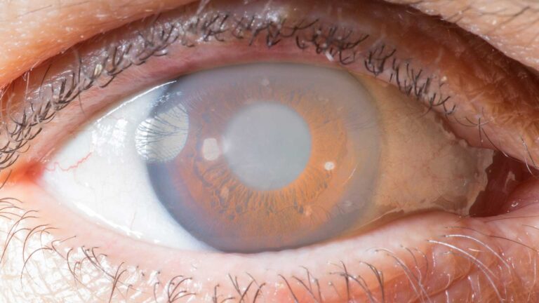 blog-image-cataract-7